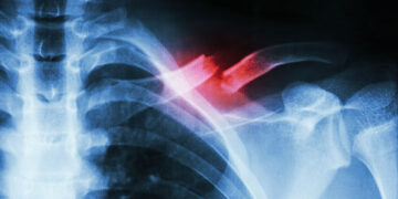 British Friendly unveils fracture cover for income protection