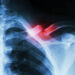 British Friendly unveils fracture cover for income protection